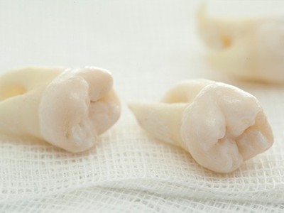 智齒疼了，這牙非拔不可嗎？