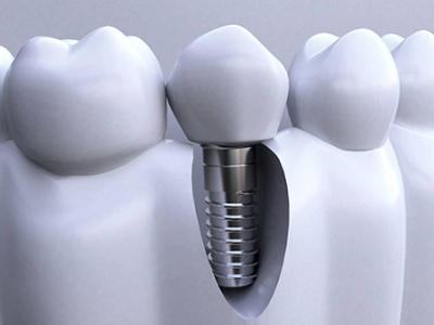 承德種植牙價格表，2024種植牙多少錢一顆呢?