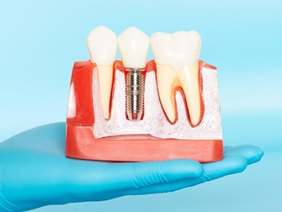 種牙VS鑲牙，你適合哪種?