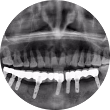 數(shù)字化導板提高種植準確度