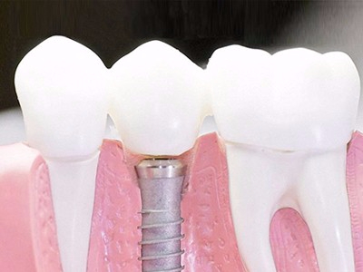 在承德口腔種植齒需要多少錢(qián)？惟德口腔一一為您道來(lái)